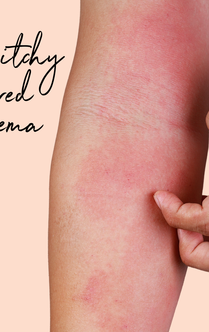 dermatitis